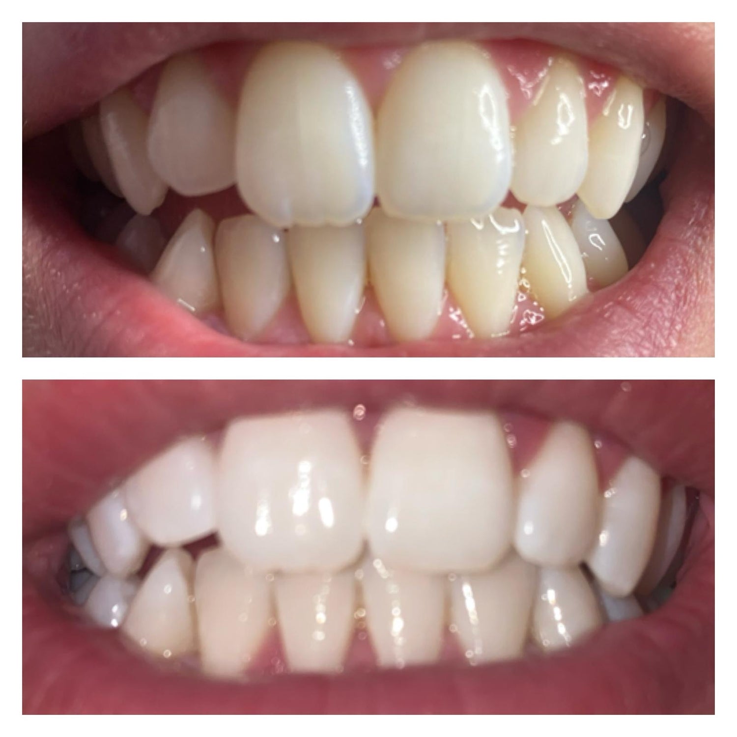 Professional Teeth Whitening Dublin | The Gow Bar