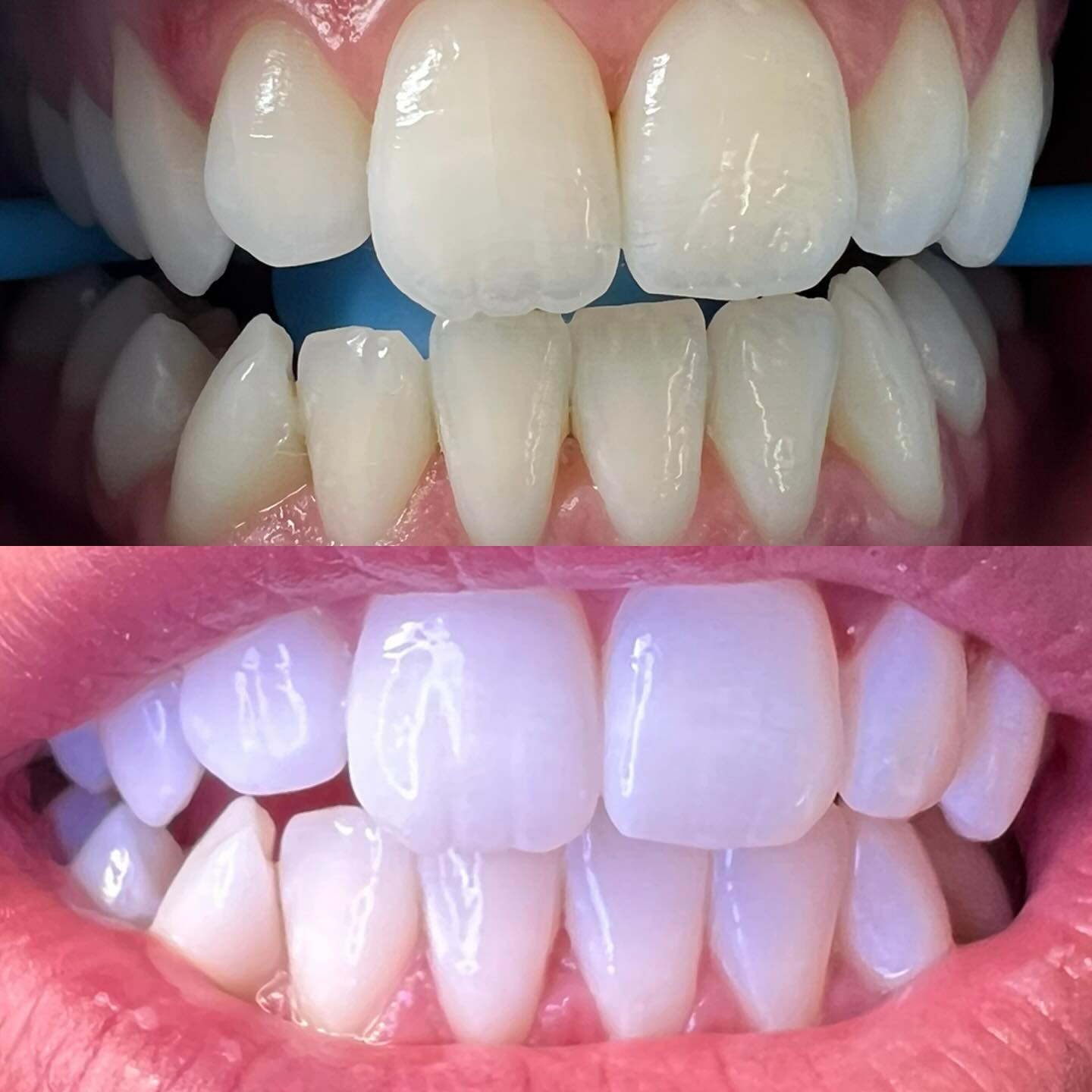 Affordable Teeth Whitening Dublin | The Glow Bar