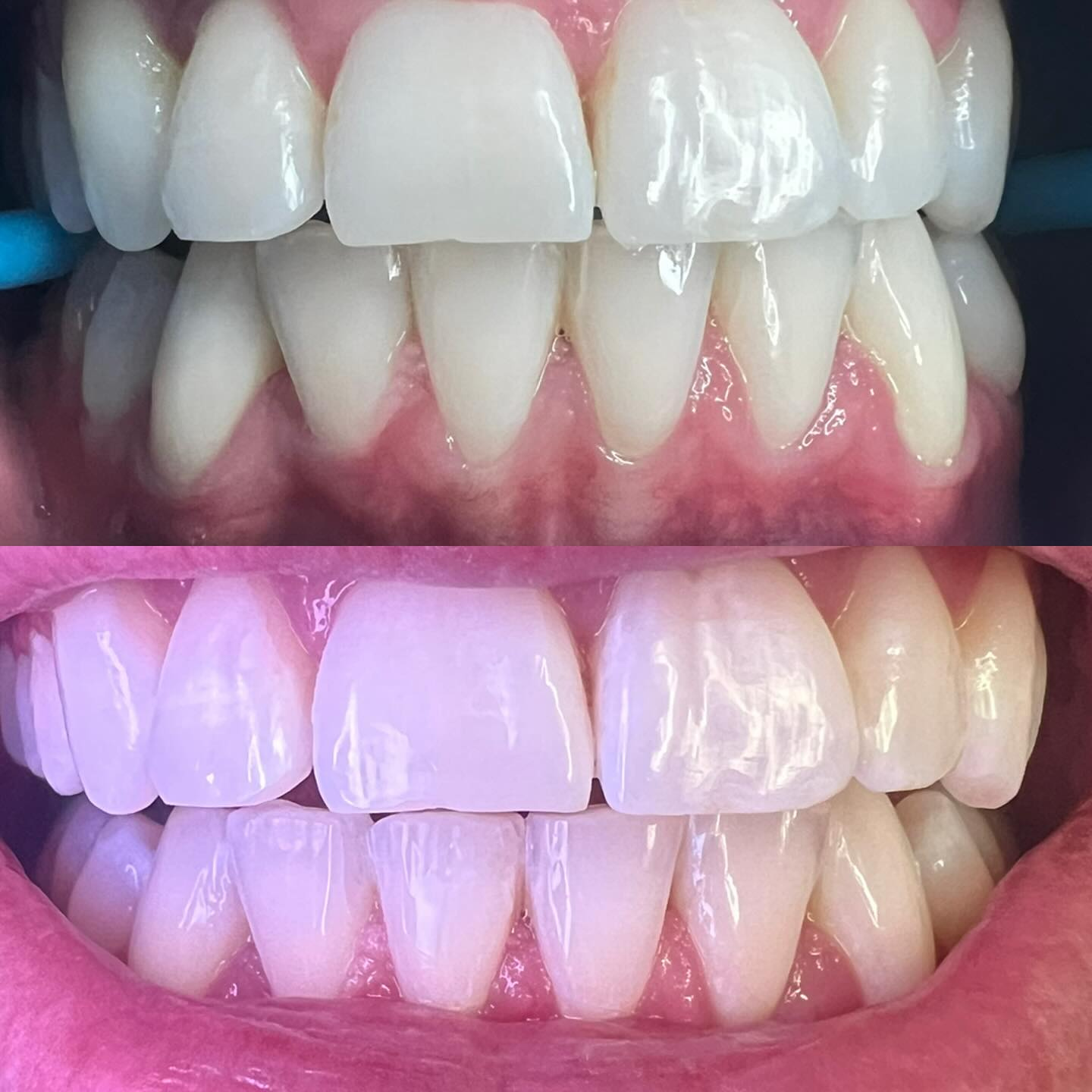 Smile  Teeth Whitening Dublin | The Glow Bar